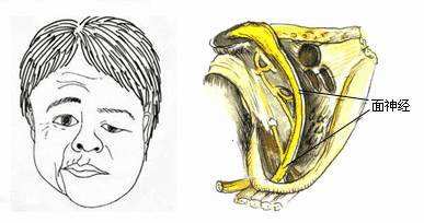 对着空调吹一晚致面瘫,夏天吹空调面瘫