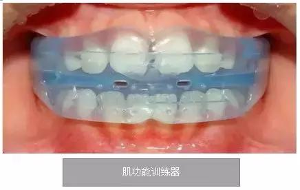 长期口呼吸的人是不是很没出息,长期口呼吸让人变丑