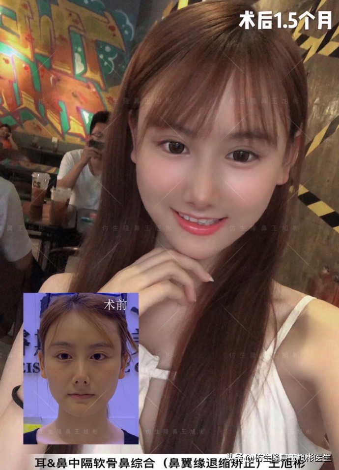 王旭彬:朝天鼻、露鼻孔,模特菲菲短鼻矫正手术后1.5个月