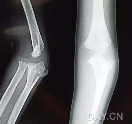 所有骨折都叫什么名字,骨折的名称有哪些