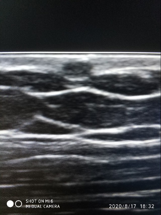 皮脂囊肿简介,皮脂囊肿和脂肪囊肿的区别