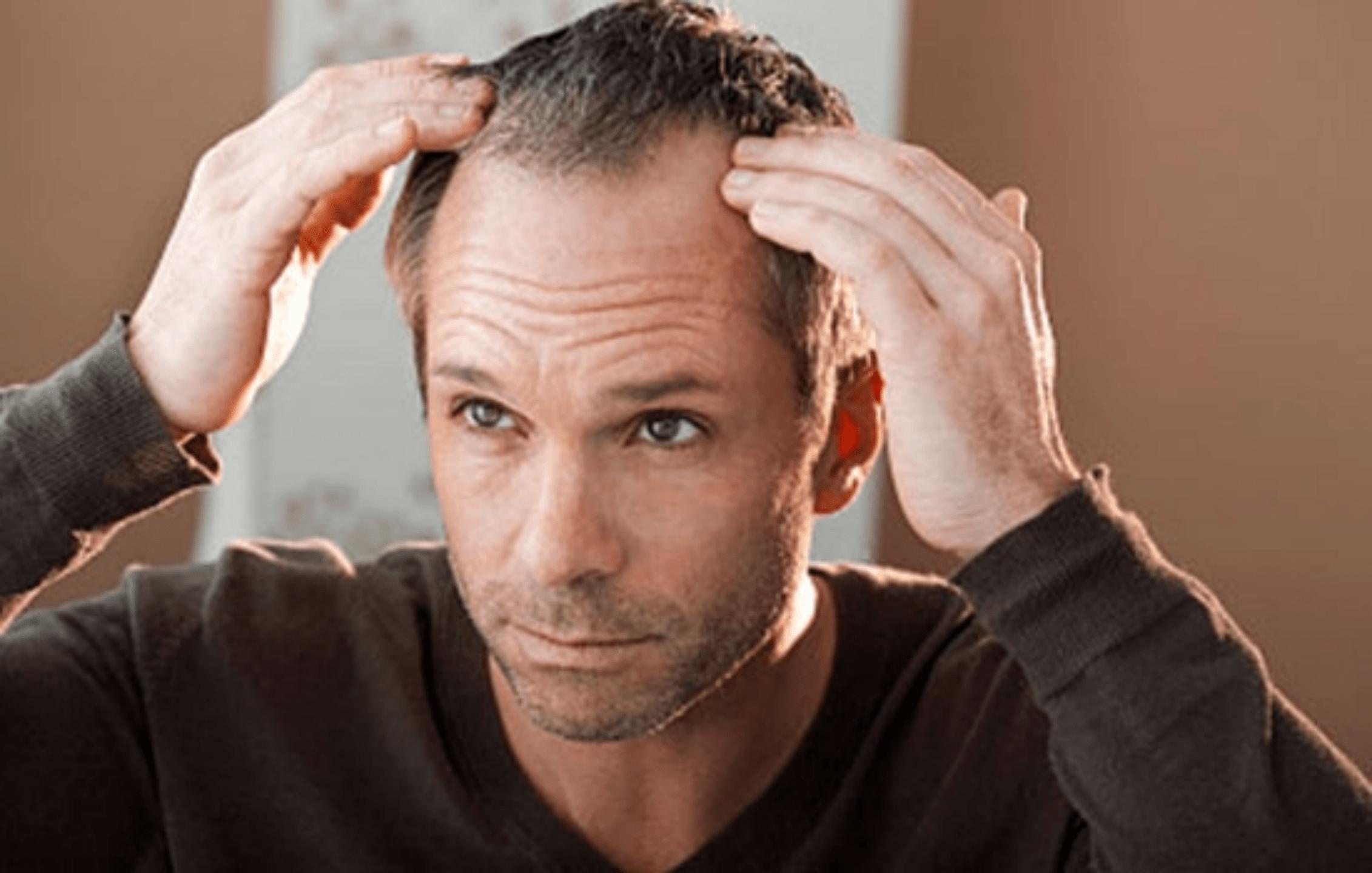 肥胖脱发的最佳治疗方法,肥胖脱发能自愈吗