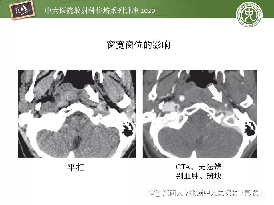 颈动脉夹层的超声表现及漏诊分析,动脉夹层与夹层动脉瘤是一样的吗