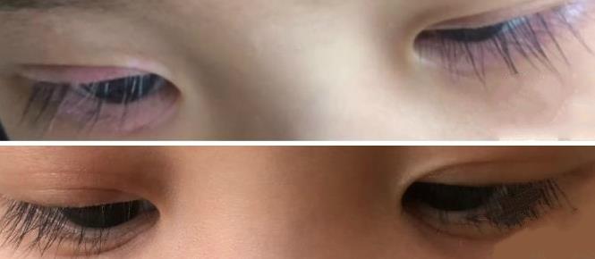 粘膜性的白癜风是怎么引起的,粘膜部位白癜风怎么治疗