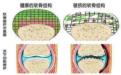 关节软骨磨损严重可置换软骨膜吗,骨性关节炎能通过注射修复软骨吗