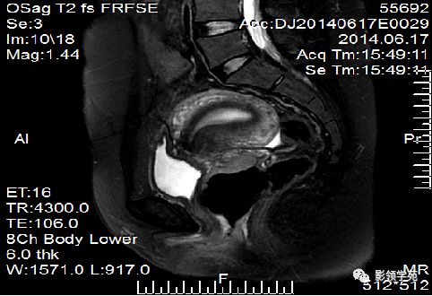宫颈癌mri诊断,宫颈癌的mr扫描技术