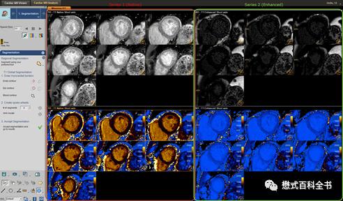 心脏磁共振定位方法,心脏磁共振各参数分析