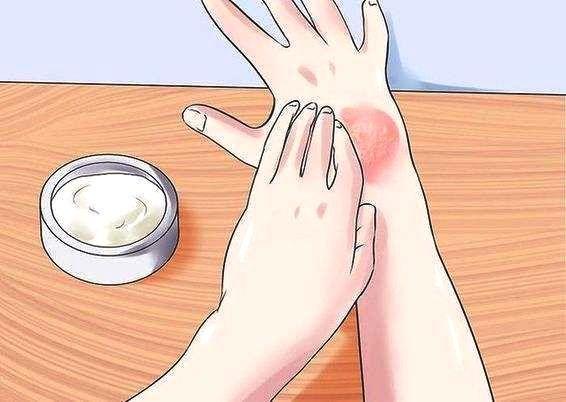 干癣成因,干癣是什么原因