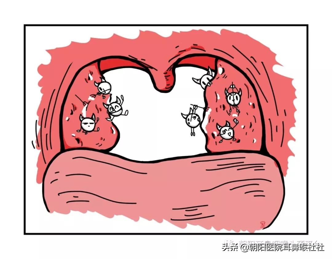 扁桃体是属于咽喉吗,扁桃体属于上咽部还是下咽部