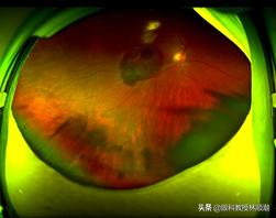 熬夜短时间眼底出血,眼底大出血失明