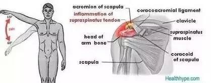 中医怎么看肩膀冈上肌疼痛,肩膀冈上肌疼痛