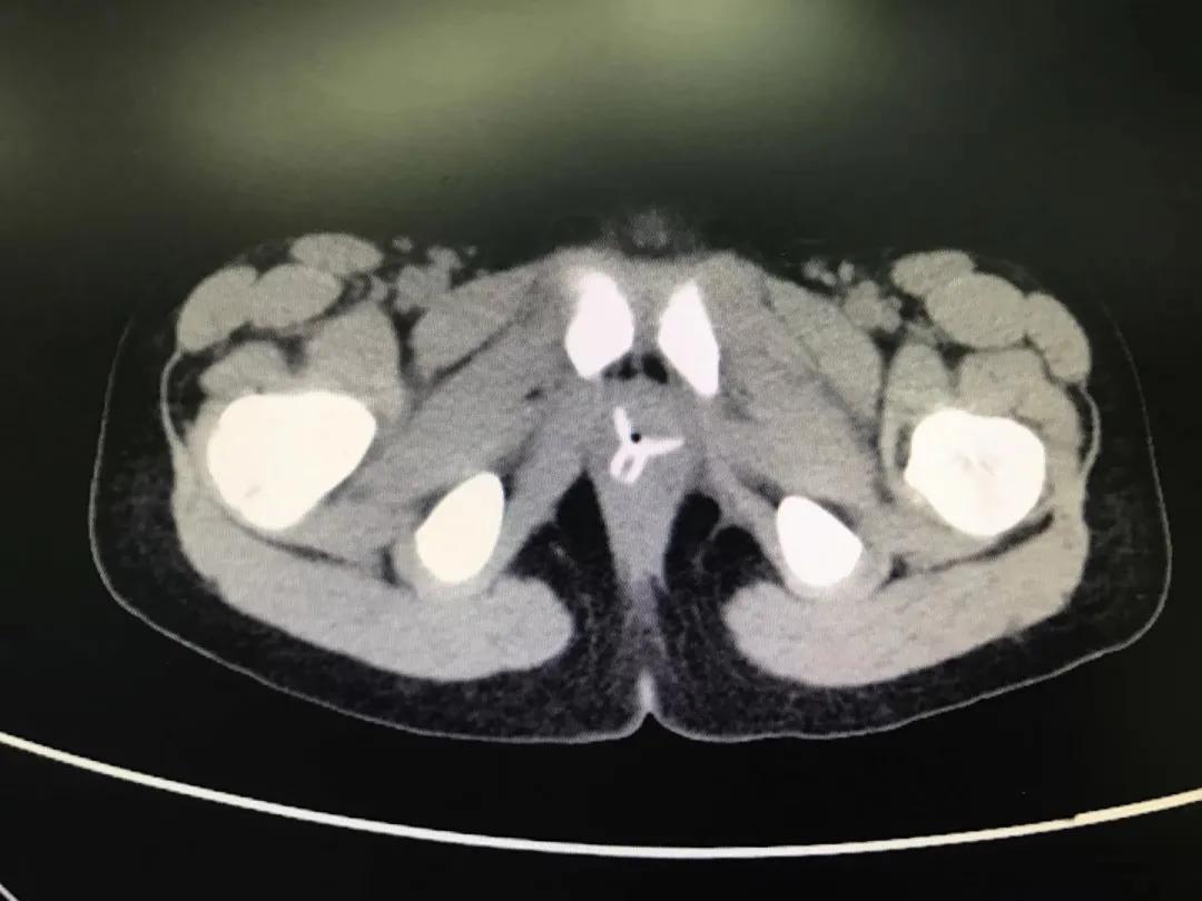 四岁小男孩往小丁丁里塞弹珠?那些年孩子塞进去的东西远不止这个