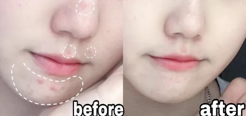 片仔癀祛痘痘产品,片仔癀可以改善痘痘肌吗