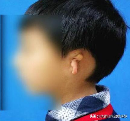 先天性小耳矫正,小耳畸形宝宝家长