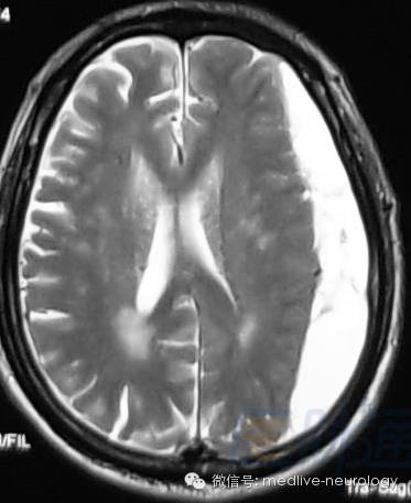 脑出血磁共振t1t2表现,10分钟记住脑出血核磁表现