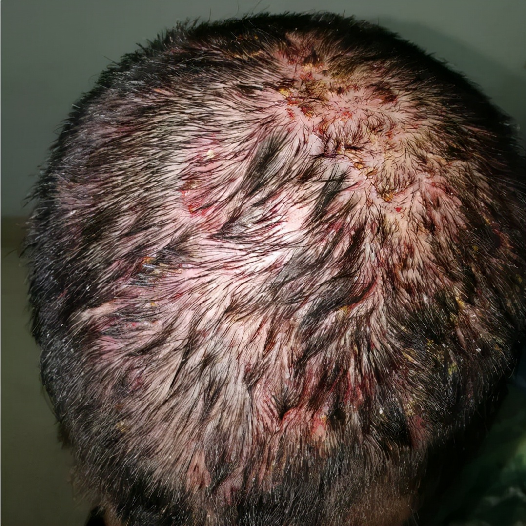 靶向药皮肤副作用怎么缓解,靶向药物副作用引起皮肤溃烂图片