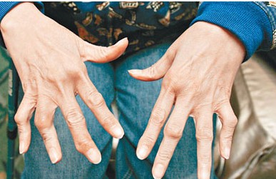 如何预防链球菌感染风湿性关节炎,风湿性关节炎怎么治才能根除