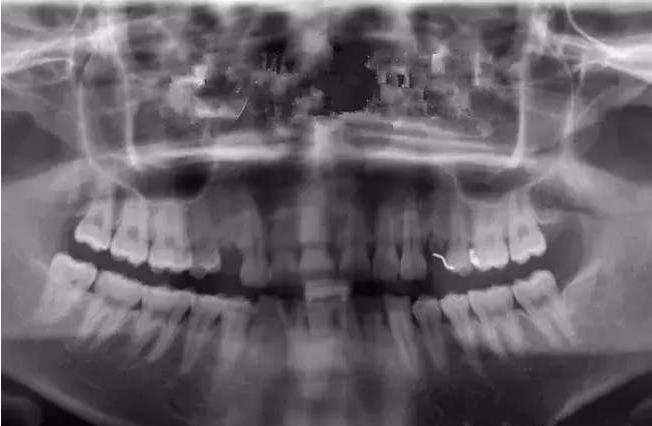 正畸基本操作,口腔正畸常用技巧