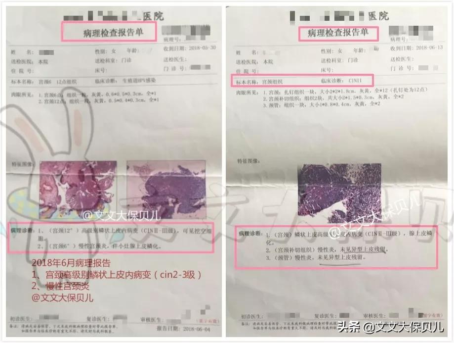 宫颈癌前病变cin3保险理赔吗,上皮内瘤变重疾险赔付吗