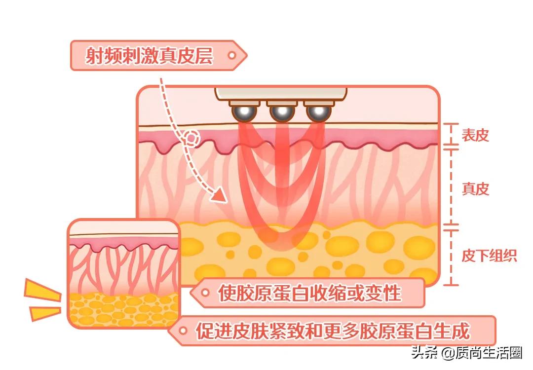 家用热玛吉美容仪多久做一次合适,热玛吉美容仪自己做