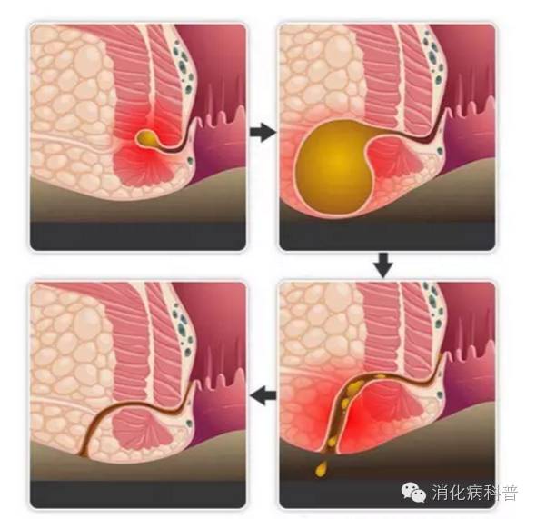 喝酒对痔疮和肛瘘的危害,比痔疮还严重的是什么病