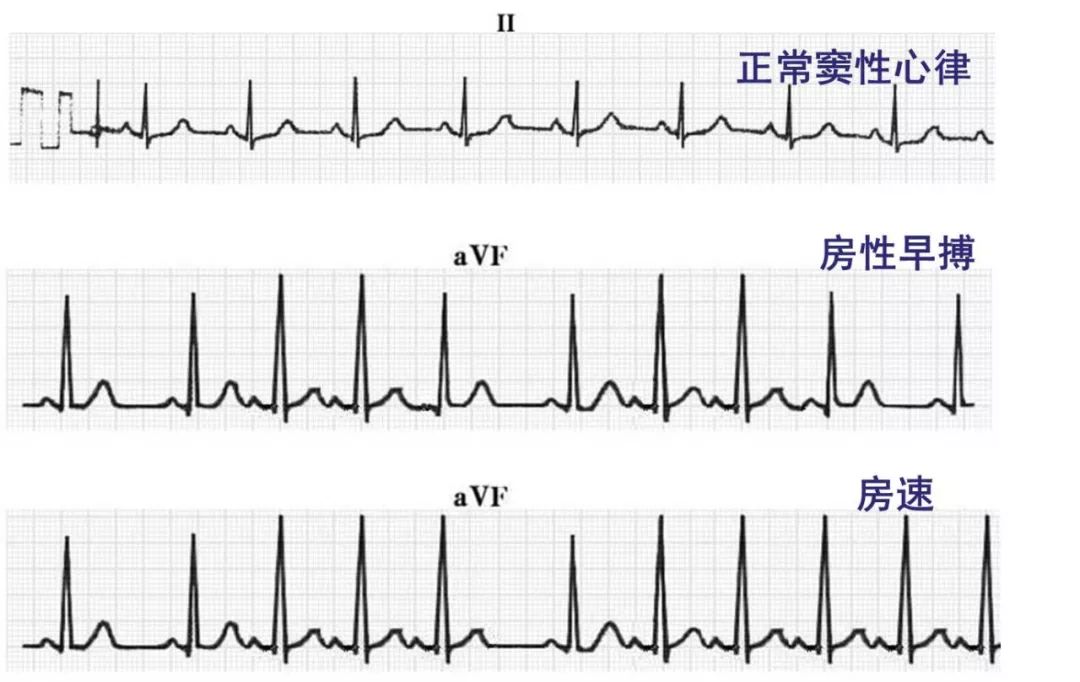心律失常55分钟讲解,心律失常心电图讲解视频教程全集