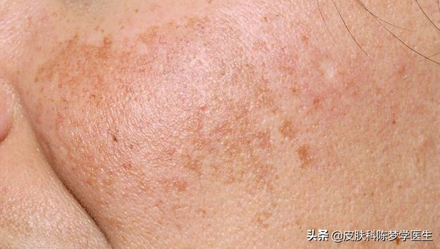 市面上的维a酸乳膏有效果吗,火爆全网的维a酸乳膏