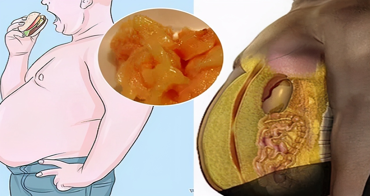 想除掉脂肪粒,想要彻底减肥