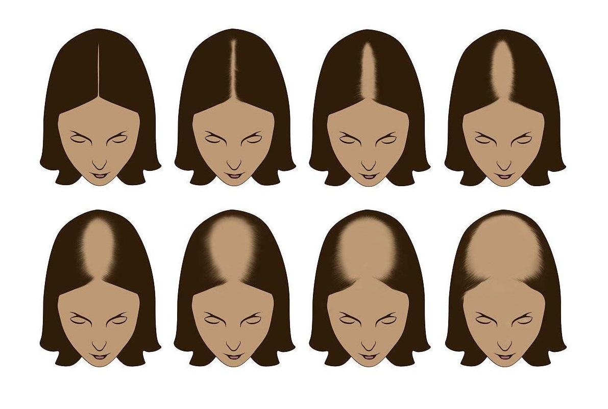 脱发的人还会长头发吗,好好的头发怎么就秃顶了呢