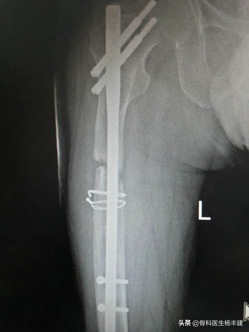 骨折手术后需要注意，什么情况下容易出现钢板断裂？