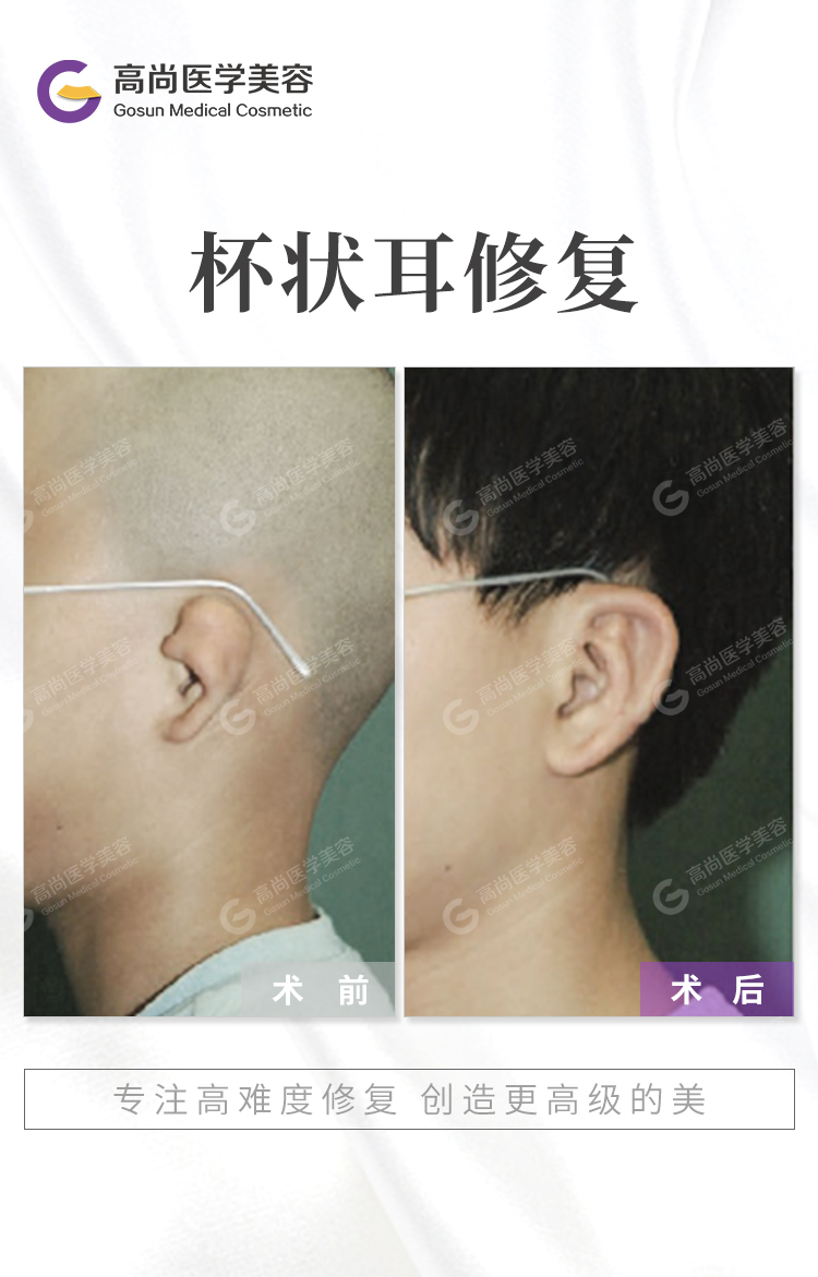 余文林小耳畸形常见问题汇总,宝宝耳朵轻微畸形