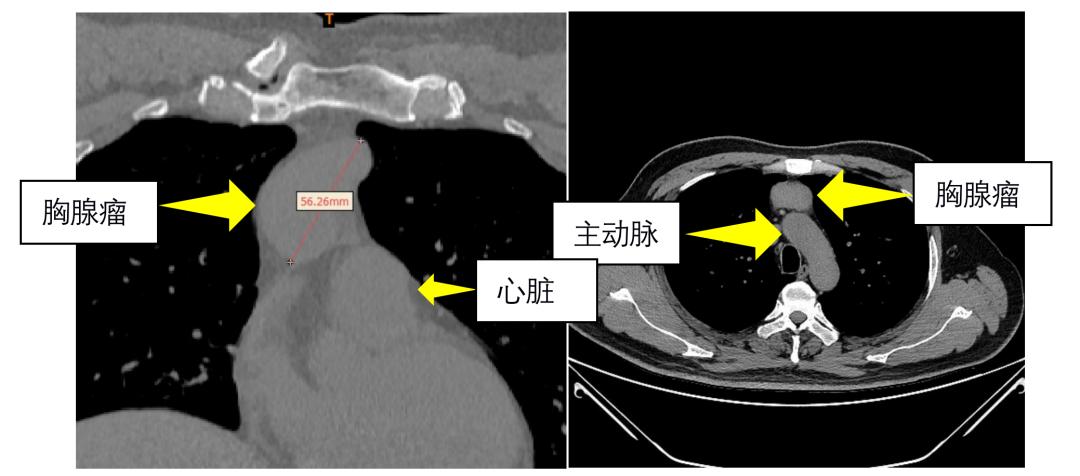 唐都医院纵隔肿瘤开胸手术,西安唐都胸外科手术