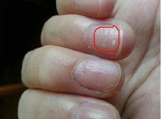 如何从手指甲上看病症,如何从指甲看疾病
