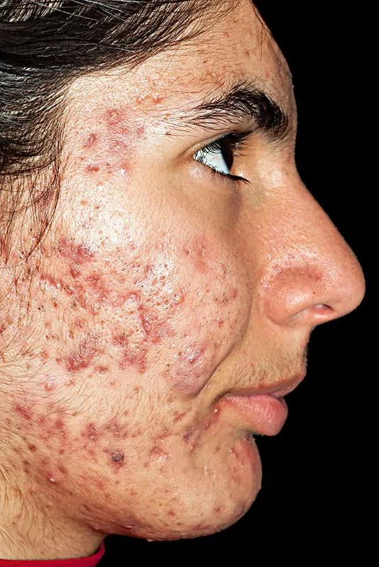 疮肿的治疗方法,疮的症状和护理办法