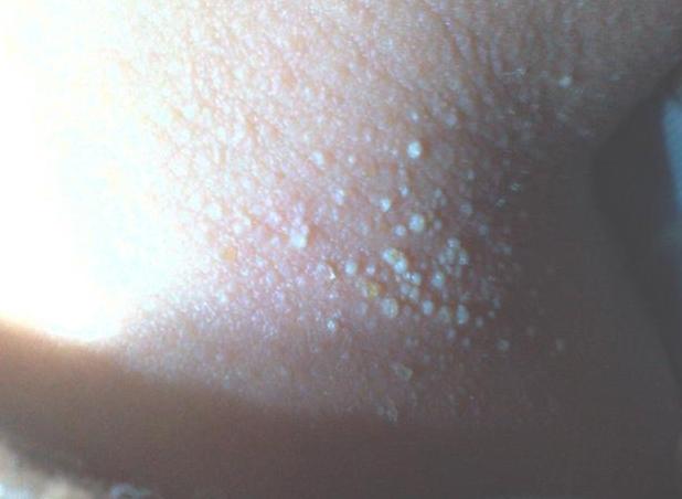 天热没空调婴儿怎么预防热痱子,宝宝热出痱子还不能吹空调吗