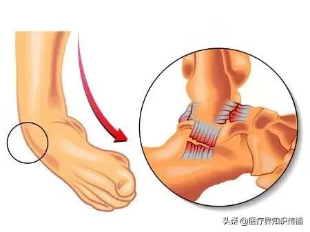 老是崴脚是怎么解决,总是崴脚纯手法教你怎么治疗