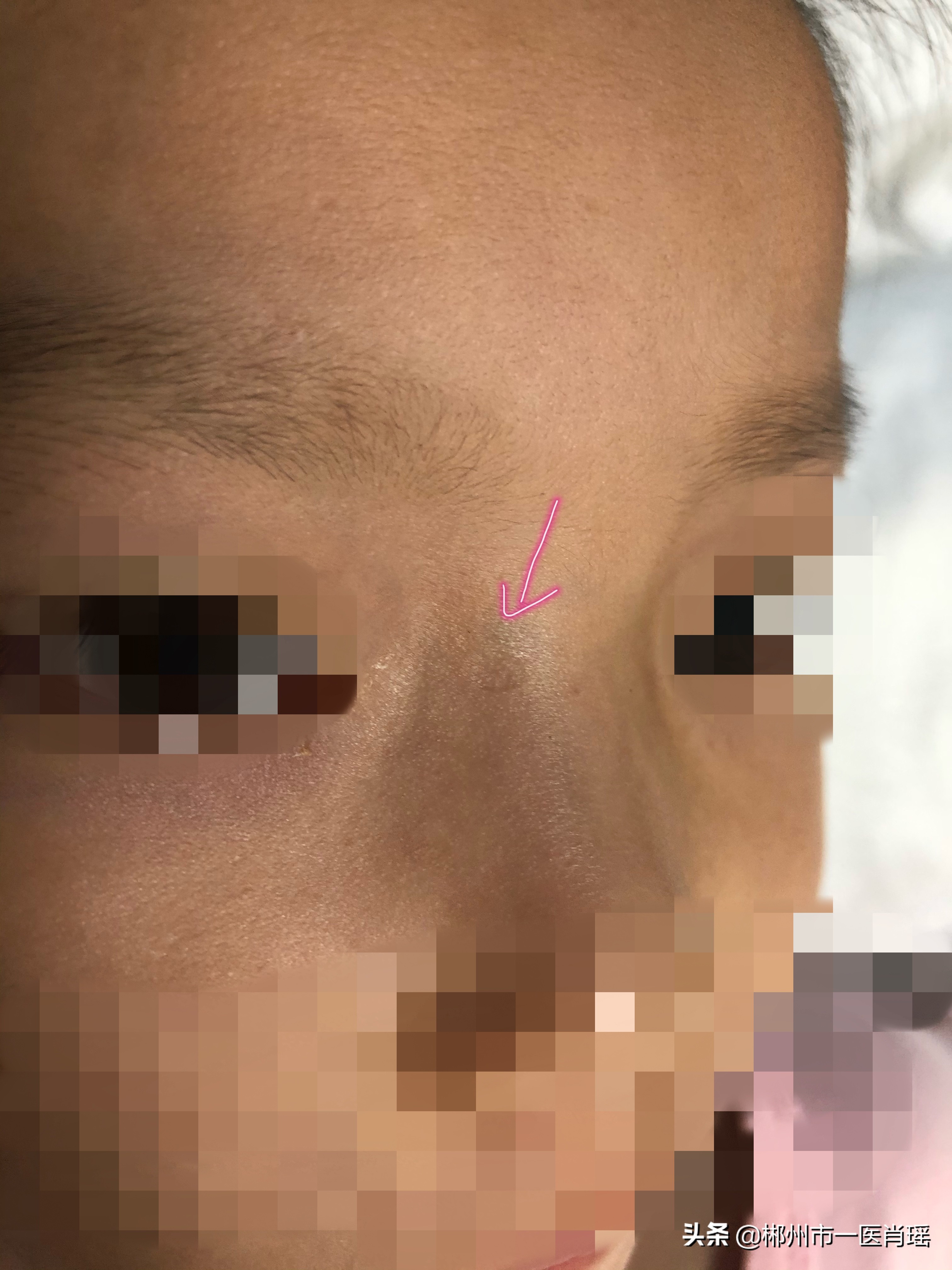 激光点痣留下的凹坑怎么修复,激光点痣会留疤有凹陷吗会好吗