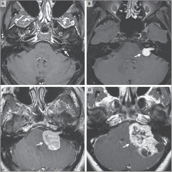 听神经瘤最新论文,听神经瘤的前沿研究