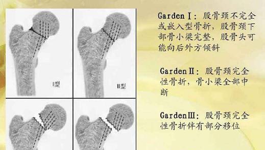 为什么股骨颈骨折后肌肉会掉,为什么髋臼骨折会导致股骨头坏死