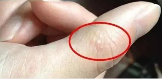 手上脚上起疙瘩又痒又痛咋回事,手上又肿又红又痒又痛还有流脓