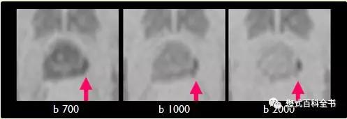 dwi成像序列,dwi序列和edwi序列