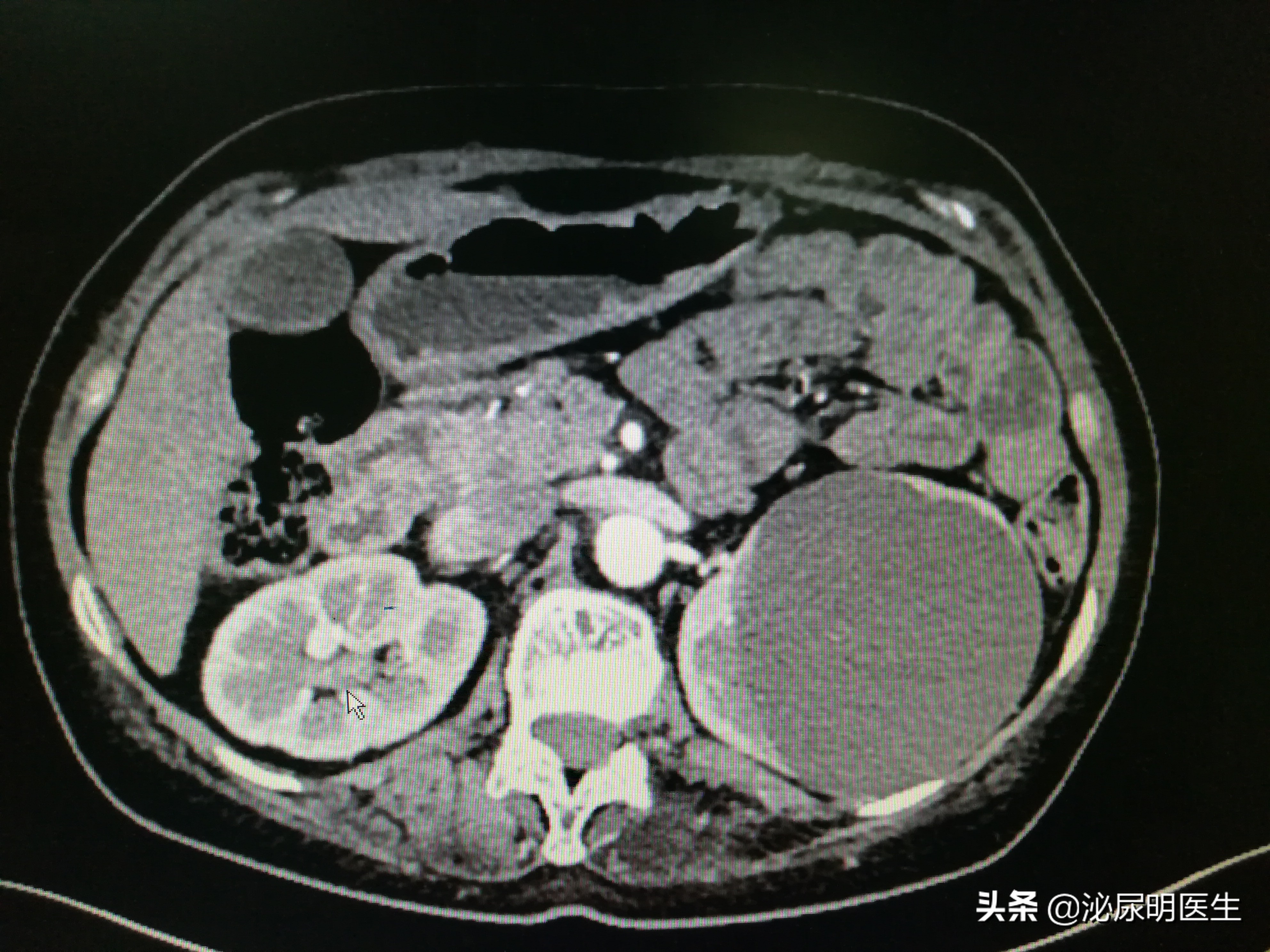 肾囊肿能穿刺引流吗,肾囊肿穿刺引流后引流管液体多