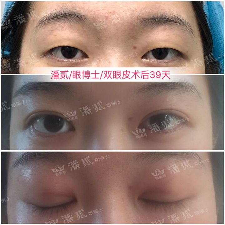 原来双眼皮不好看有必要继续割吗,割双眼皮是不是越修复越难看