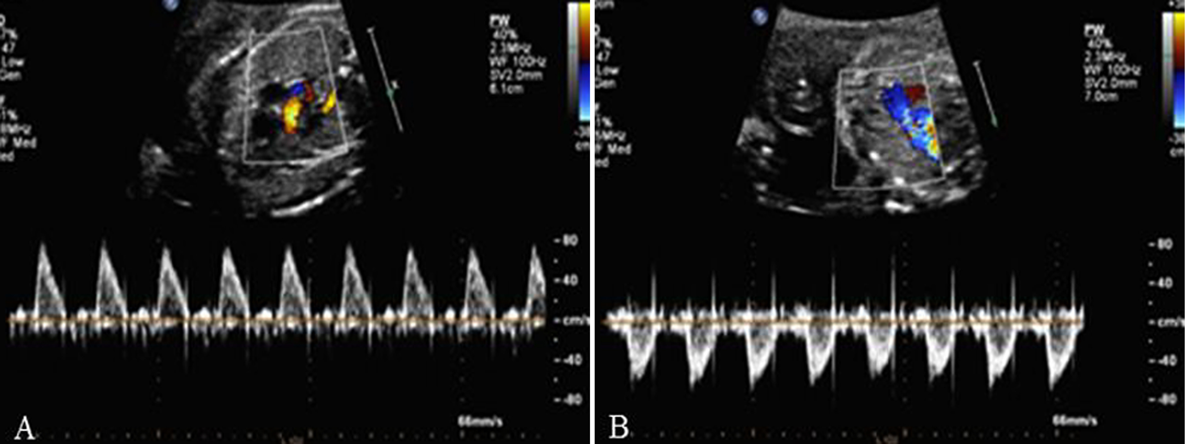 做普通的彩超能不能看到胎儿心脏,做彩超能知道胎儿准确多少周吗