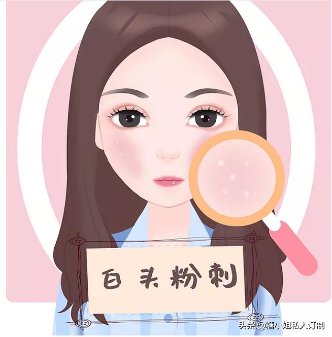 痘痘挤出小白粒怎么办,痘痘跟粉刺的区别如何快速消除