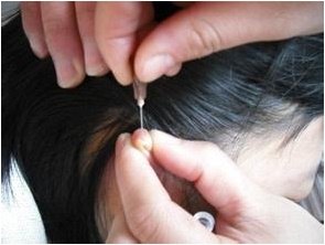 6岁男童患白癜风后遭家人放血？妈妈表示：我们也是太着急了