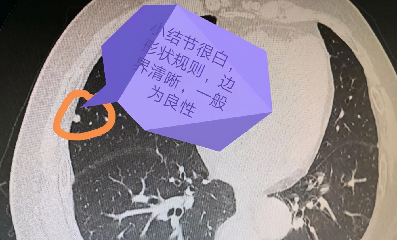 请问专家肺结节吃什么药能治,专家对肺结节的治疗