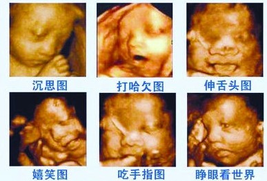 做四维彩超宝宝的表现各异，医生的暗示更是有趣，这项检查很重要