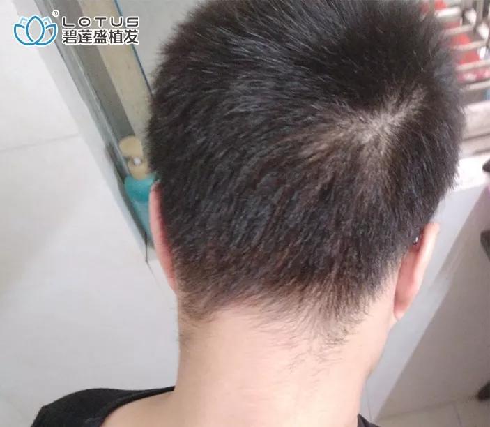 发际线后移额角大头发稀疏怎么办,额角发际线还能恢复吗