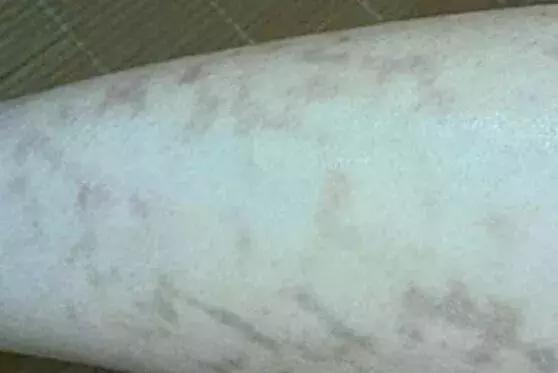 神器变“暗器”：暖宝宝、烤火灯致烧伤，冬天如何安全取暖？